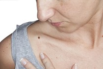 Ứng dụng điện thoại giúp phát hiện ung thư da qua nốt ruồi