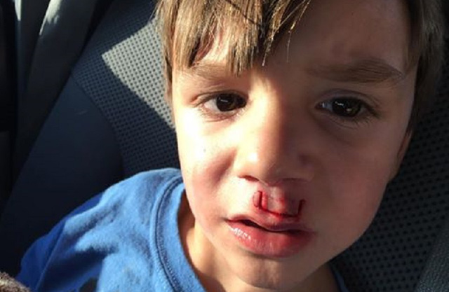 Fidget Spinner phát nổ gây chấn thương và bài học đằng sau tai nạn này