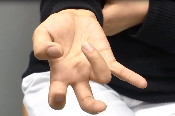 Chơi game trên điện thoại không ngừng nghỉ, cô gái suýt tí nữa thì bị liệt cả ngón tay