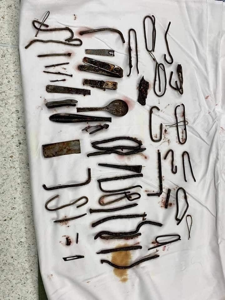 [Chuyện kinh dị có thật] Phẫu thuật lấy ra hơn 1kg sắt trong bụng một thanh niên ở Bình Dương