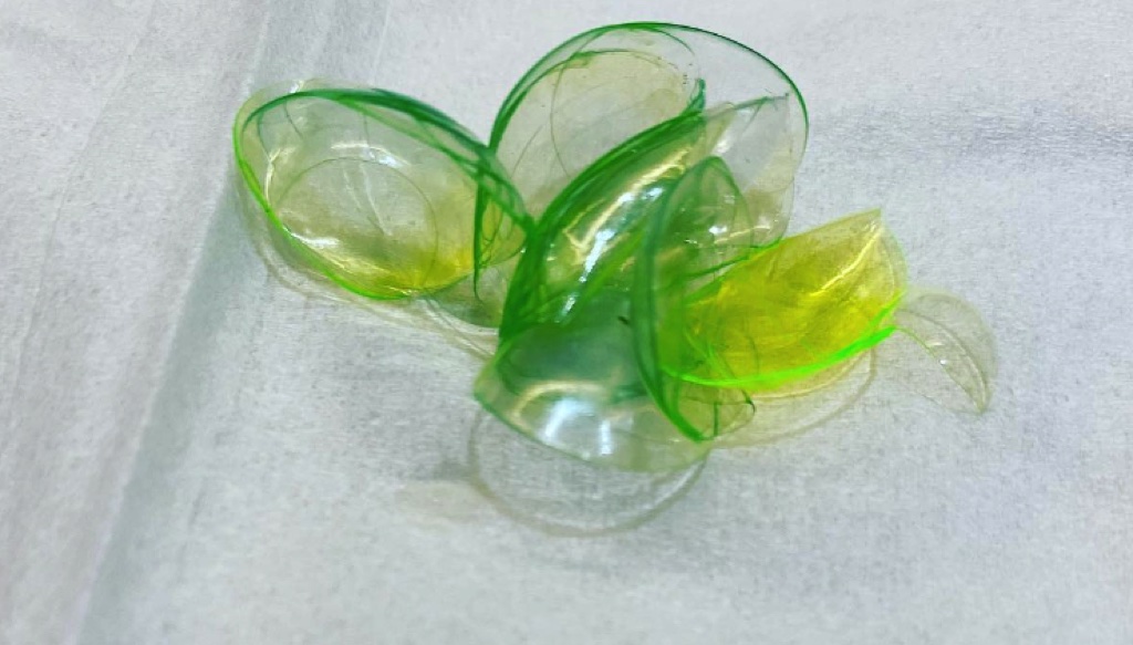 Kinh hãi với người phụ nữ bỏ quên 23 kính áp tròng trong mắt nhiều năm trời 