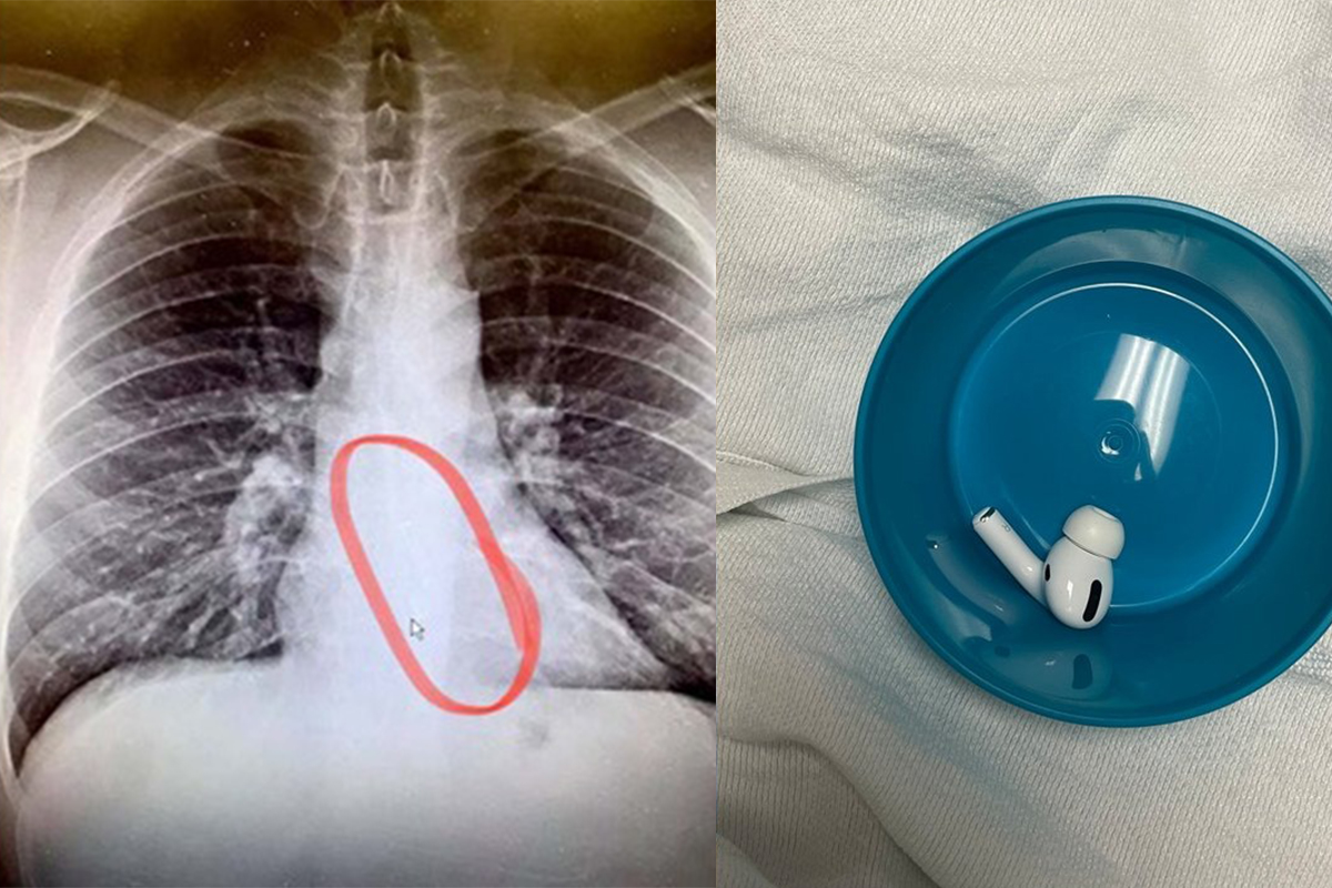Hi hữu chiếc AirPods bị một cô nàng nuốt vào bụng và vẫn hoạt động tốt sau 9 giờ năm trong dạ dày